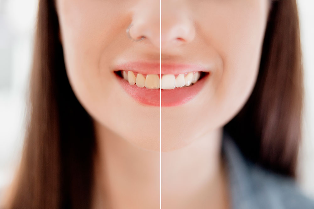 Actualment esteu veient 10 consells que no hem d’oblidar sobre un emblanquiment de dents