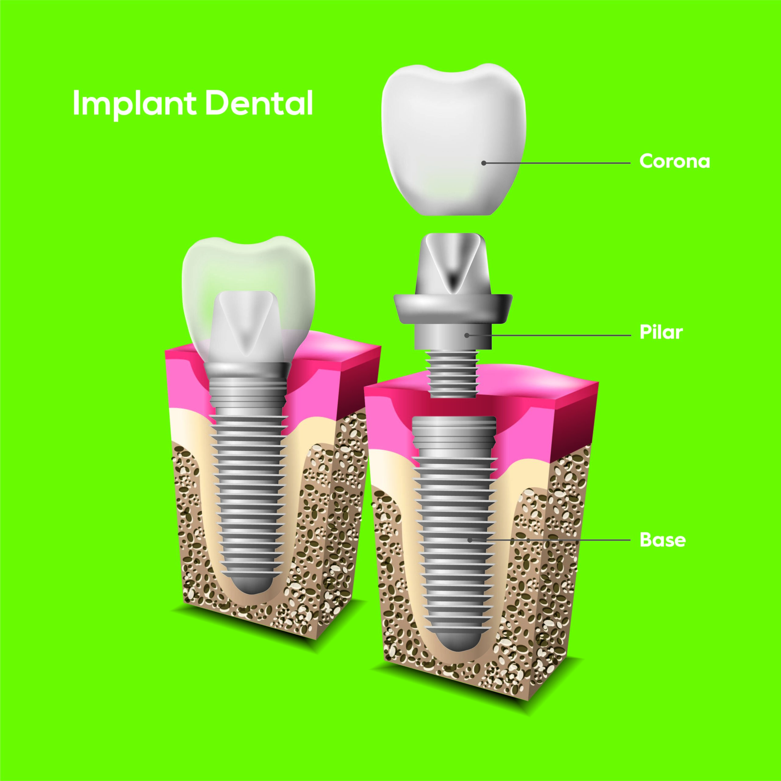 Actualment esteu veient 6 preguntes sobre els implants dentals