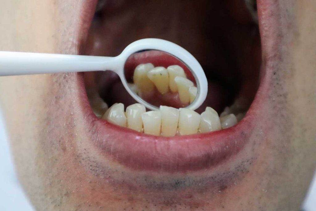 Revisión dental de los dientes inferiores