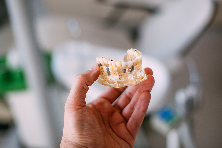 Més informació sobre l'article La importància de la qualitat dels materials en els implants dentals