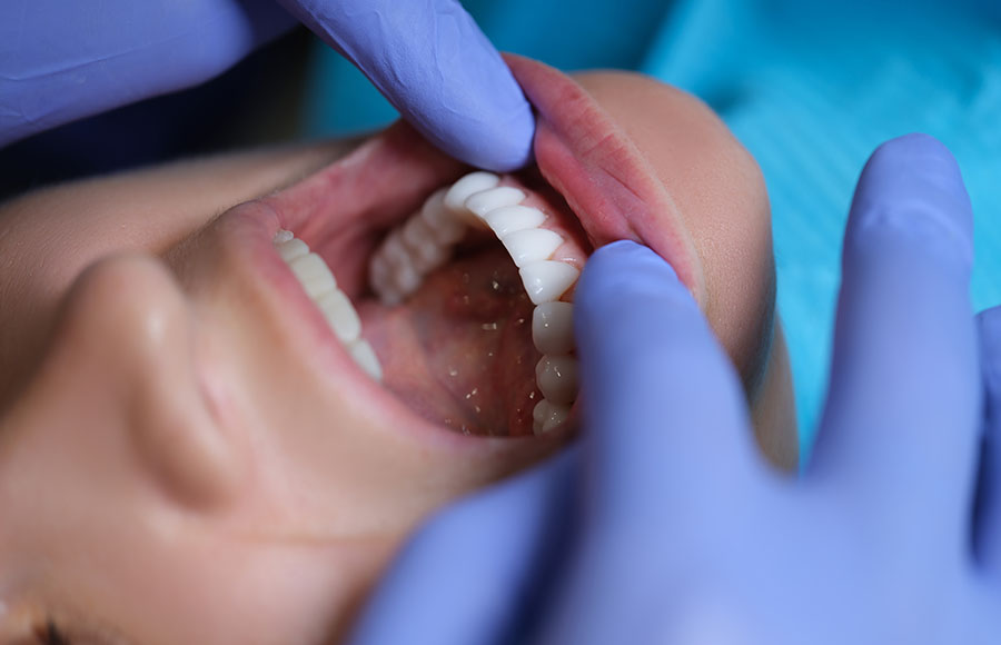 En este momento estás viendo Carillas dentales: ¿son recomendables?