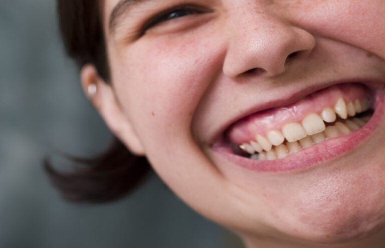 Lee más sobre el artículo Corrección de la sonrisa gingival: causas y tratamientos